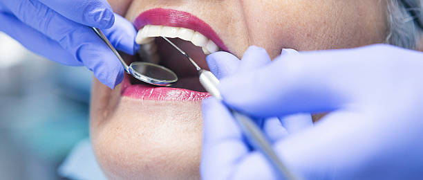 Teeth Whitening in IA